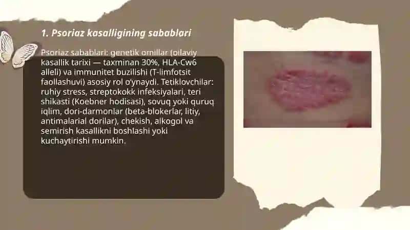 Psoriaz kasalligi 3