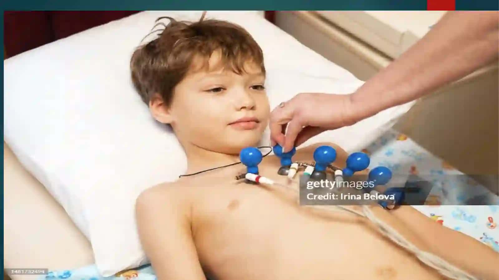 YANGI TUG’ULGAN CHAQALOQLARDA EKG NING O’ZIGA XOS XUSUSIYATLARI 3