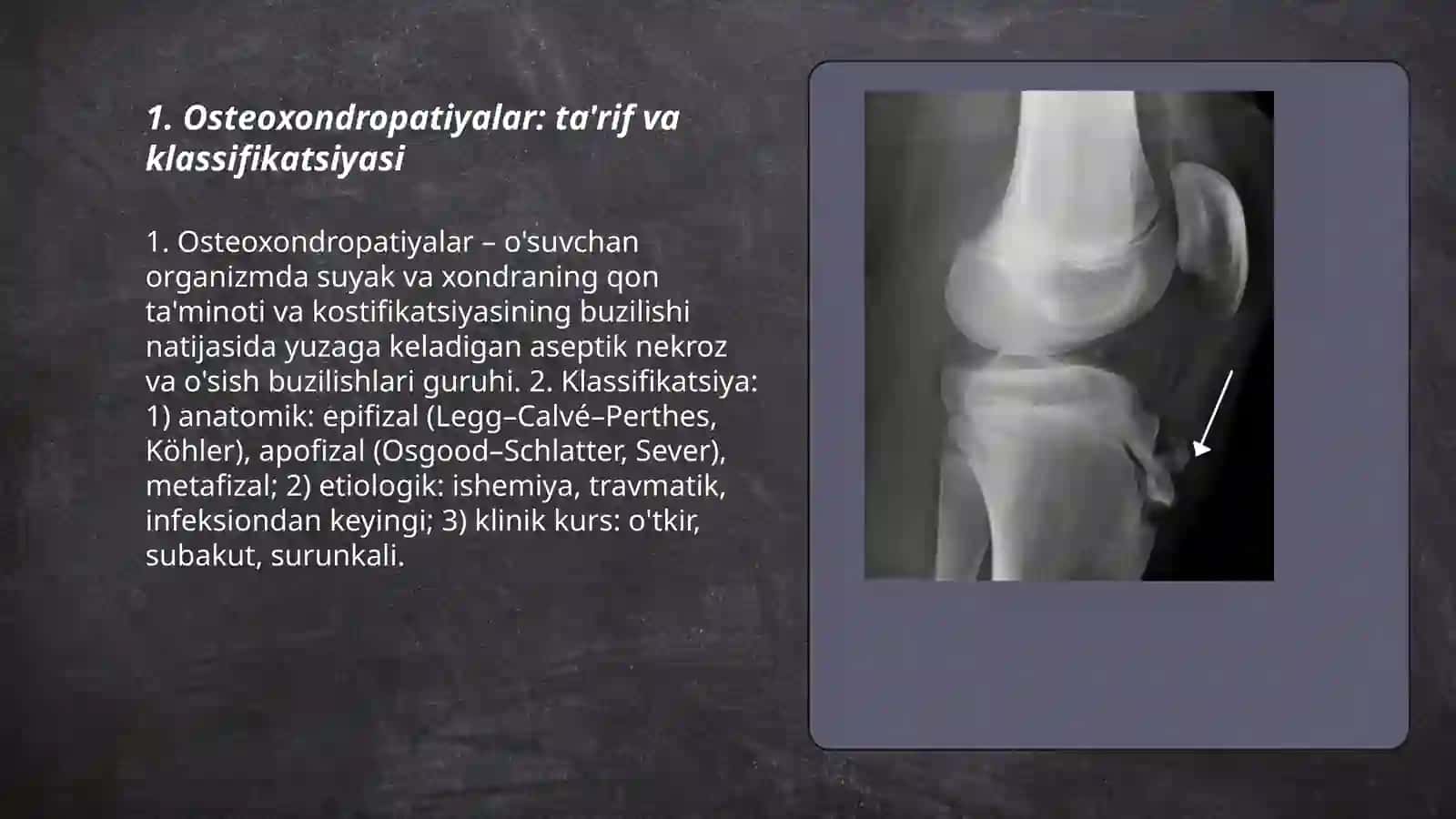 Osteoxondropatiyalar. Skolioz. Abdumannopova Nilufar 3