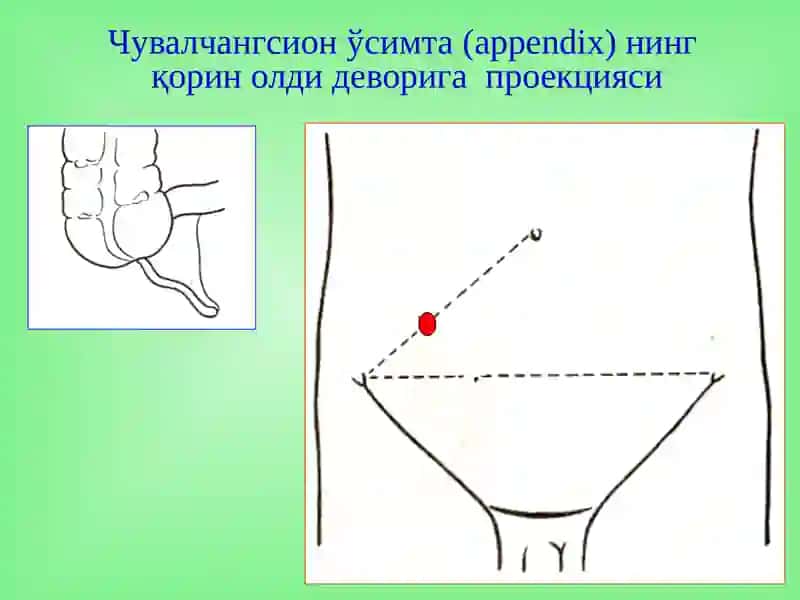 O’tkir appendetsit asoratlari 3