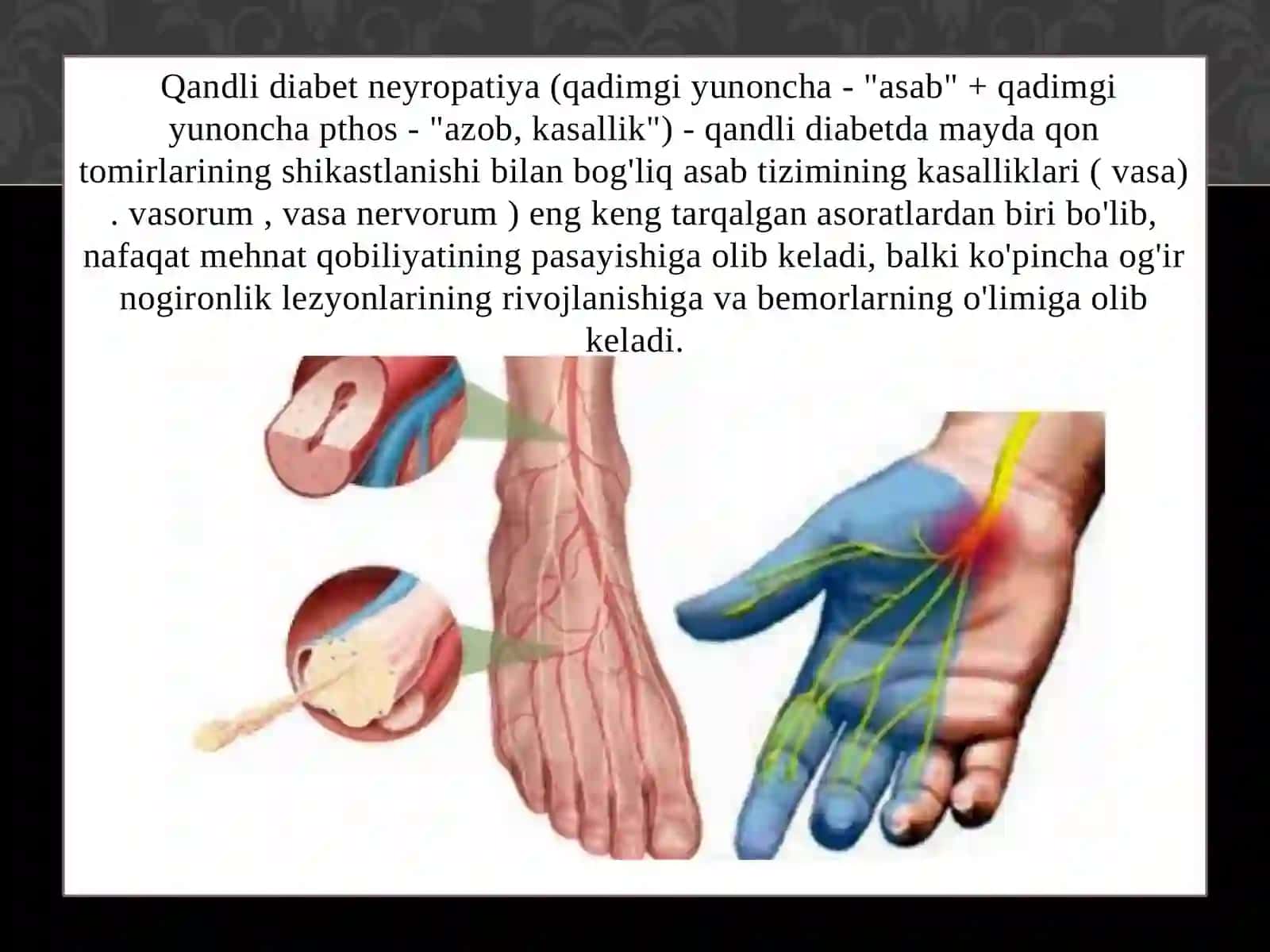 Diabetik nevopatiya 3