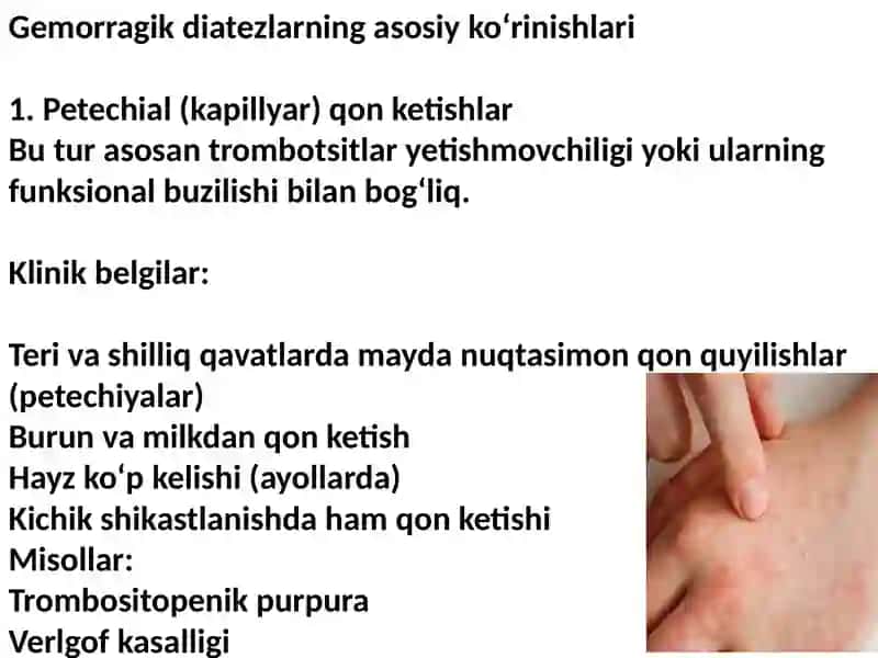 Gemorragik diatezlarning ko‘rinishlari 3