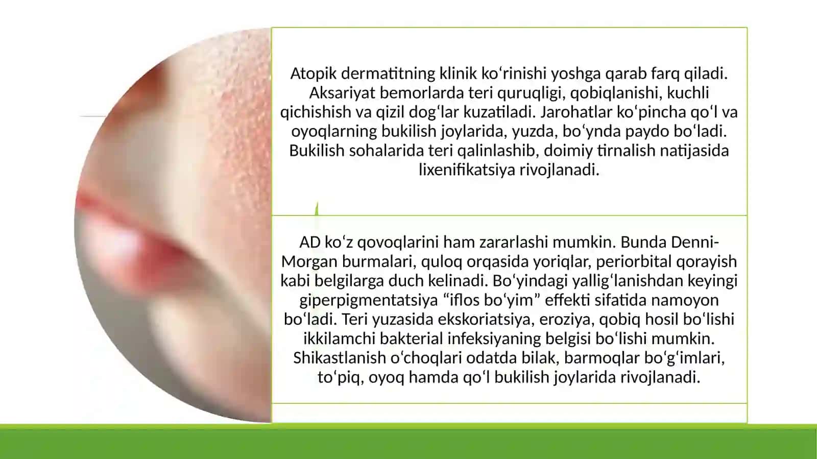 Atopik dermatit 3