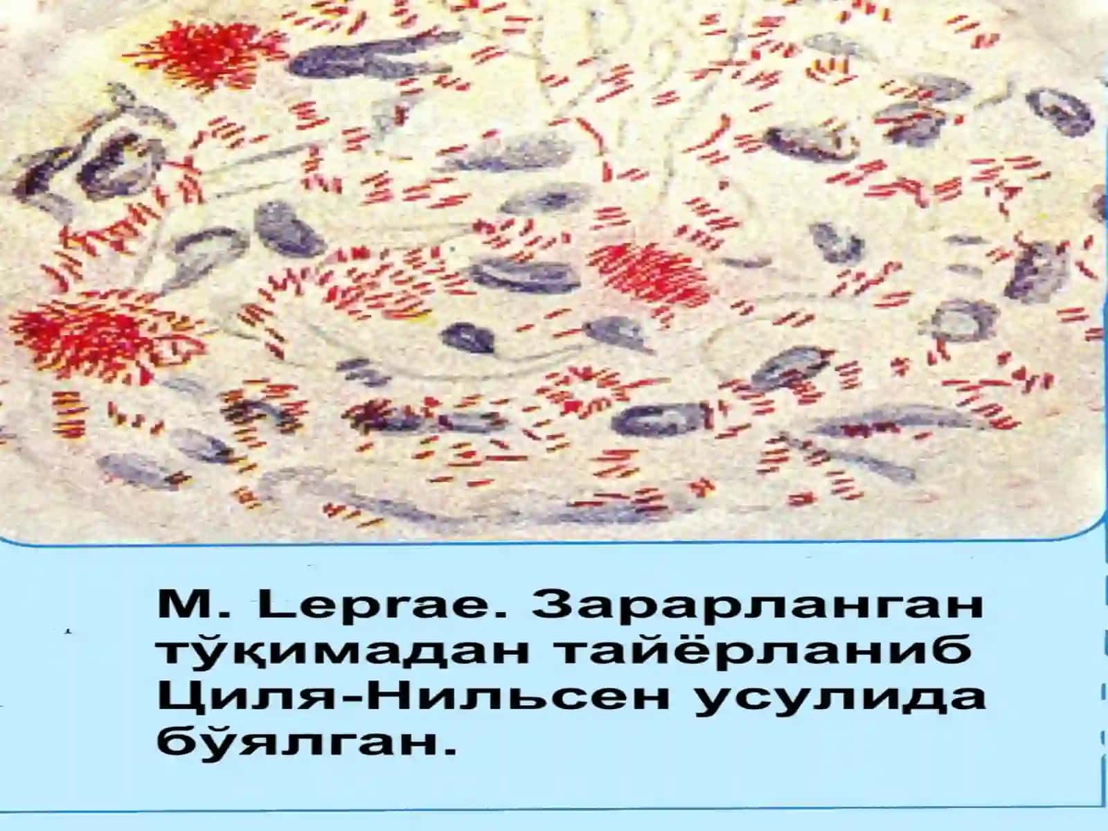 Moxoвkaсалигиқўзгатувчиси(Mycоbacterium leprae Hansen) 3