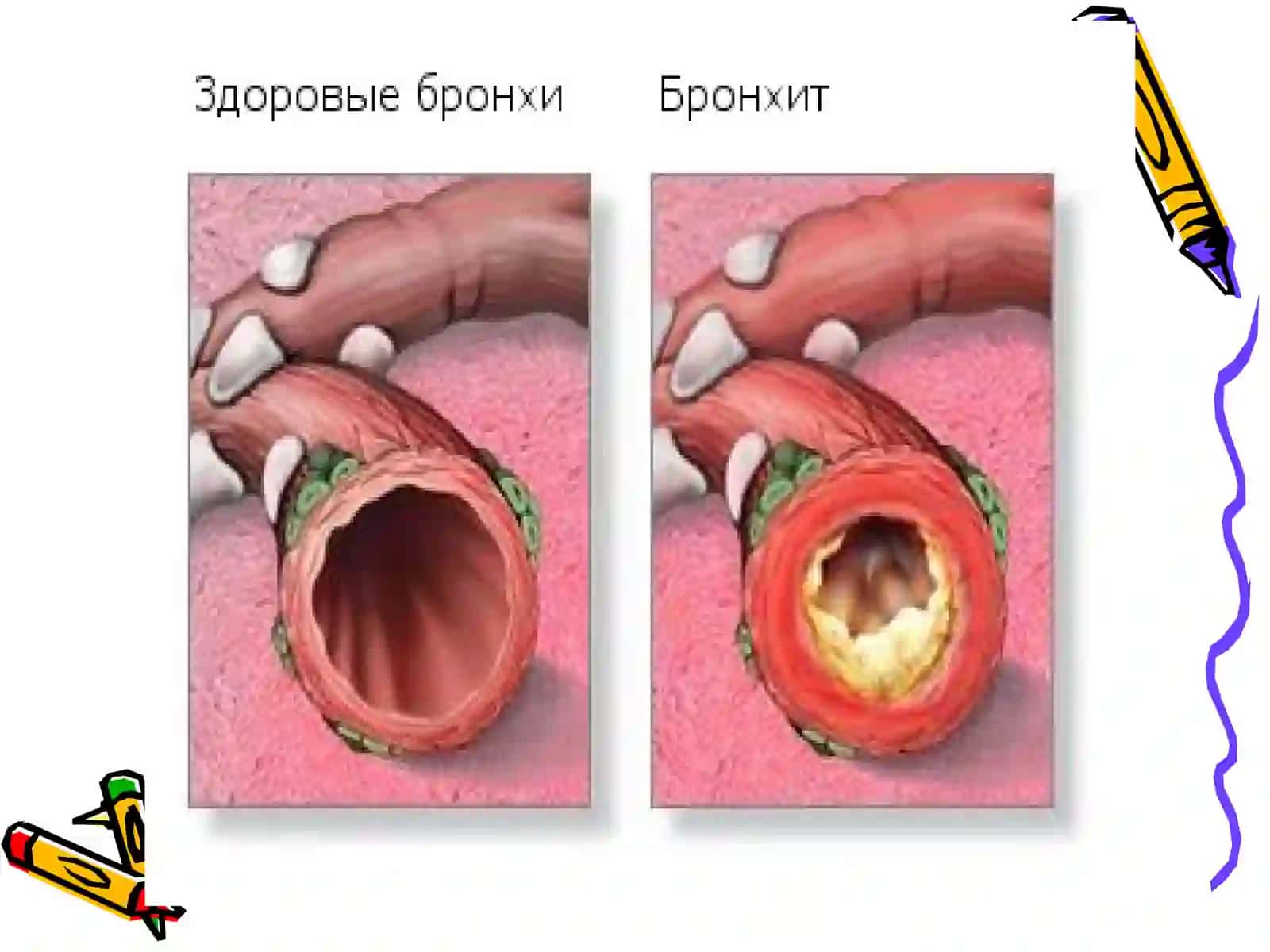 Болаларда Бронхитлар 3