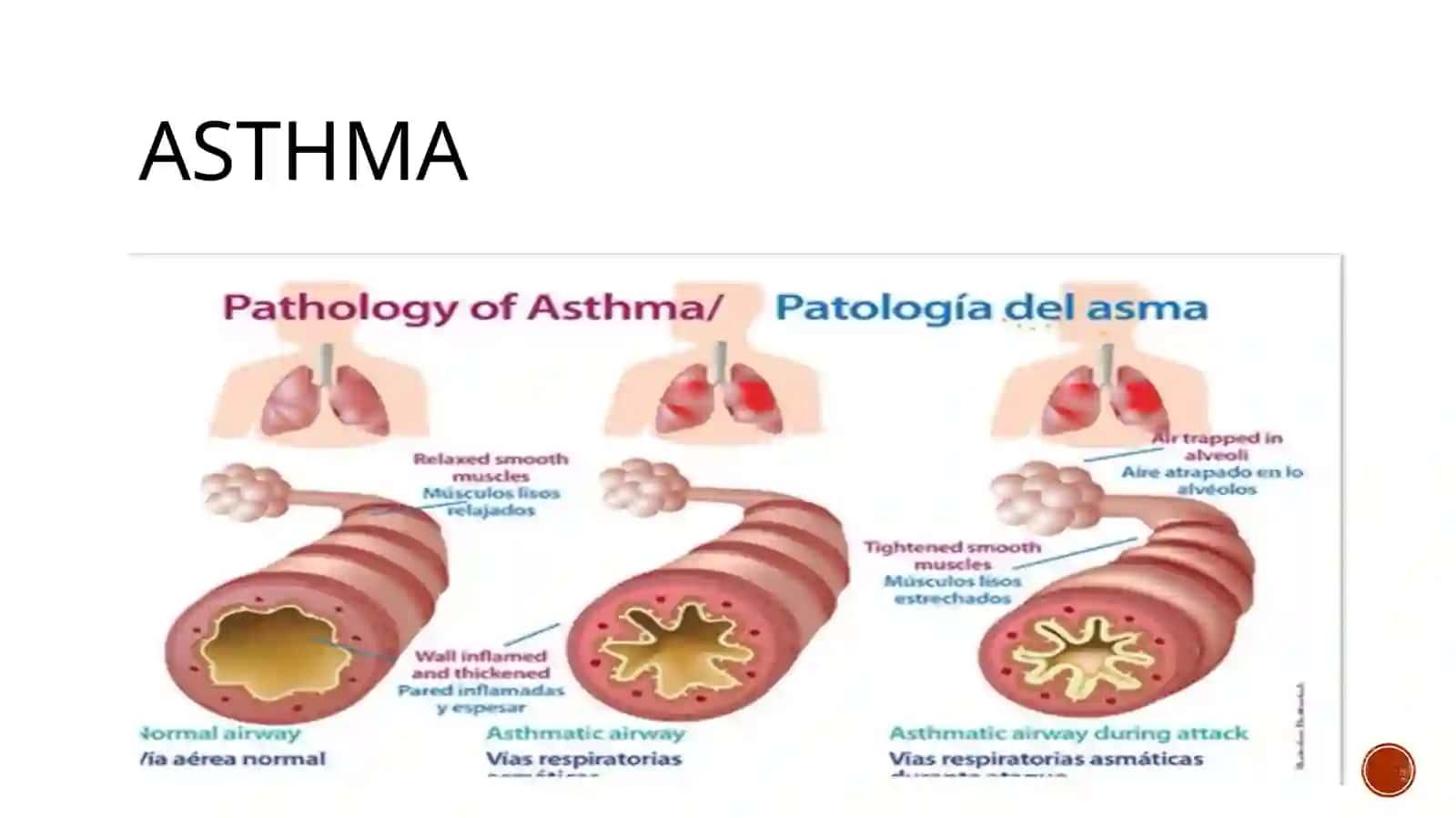Asthma 3
