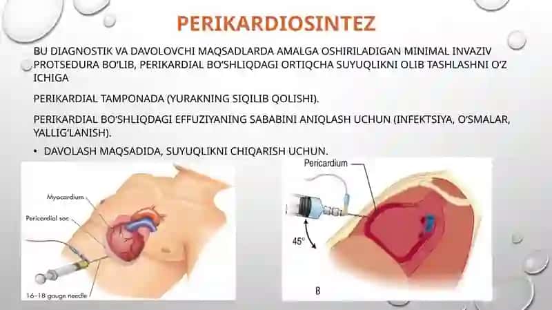 Perikarditlarda operatsiyalar 3