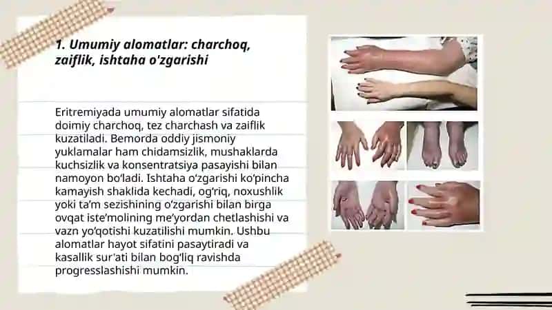 Eritremiya simptamotologiyasi 3