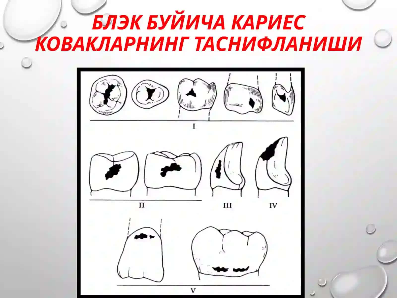 IIсинф кариоз бушликларини чархлаш ва пломбалаш 3