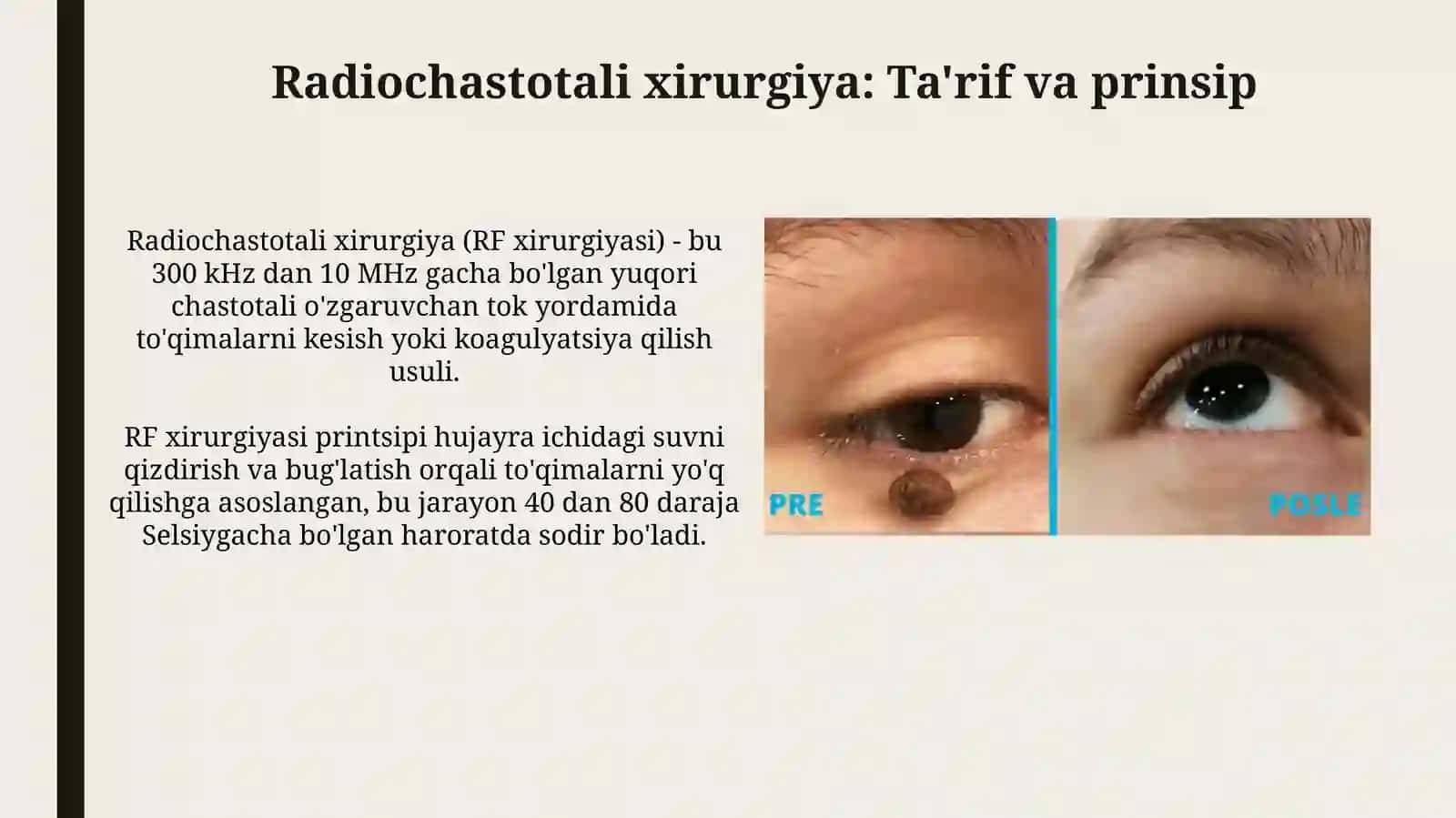 Radiochastotali xirurgiya 3
