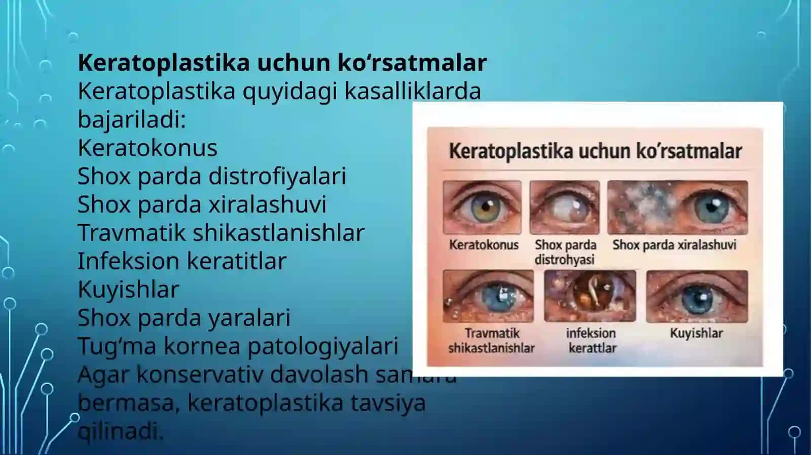 Keratoplastika, uning turlari va asoratlari 3