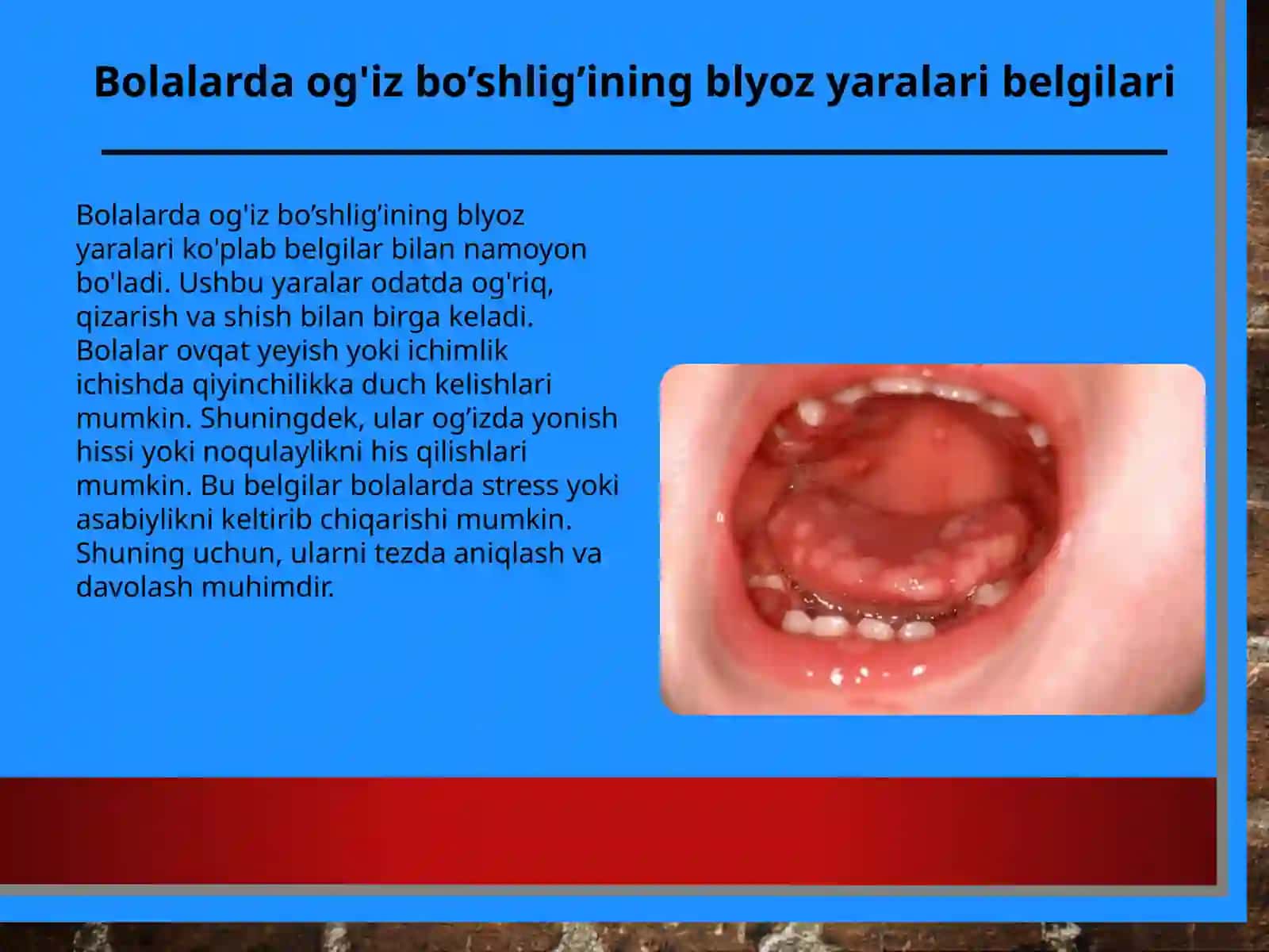 Bolalarda og'iz bo’shlig’ining blyoz yaralari belgilari 3