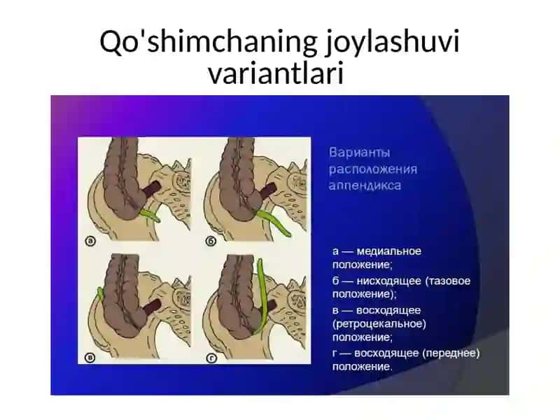 Oʻtkir appenditsita tipik kechishi 3