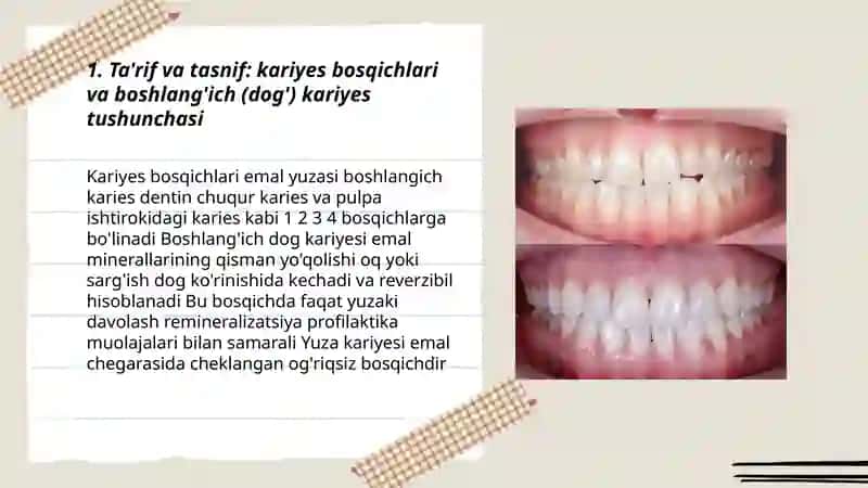 Kariyes bosqichlari 3