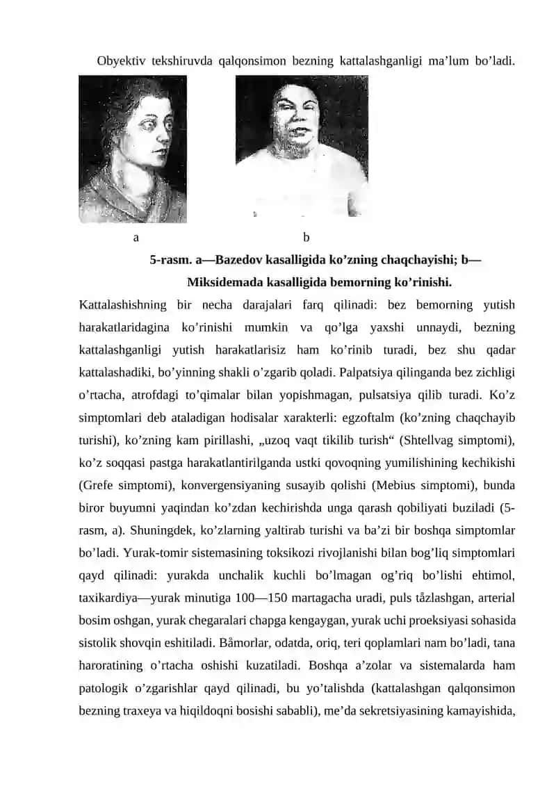 Qalqonsimon bez kasalliklari 3