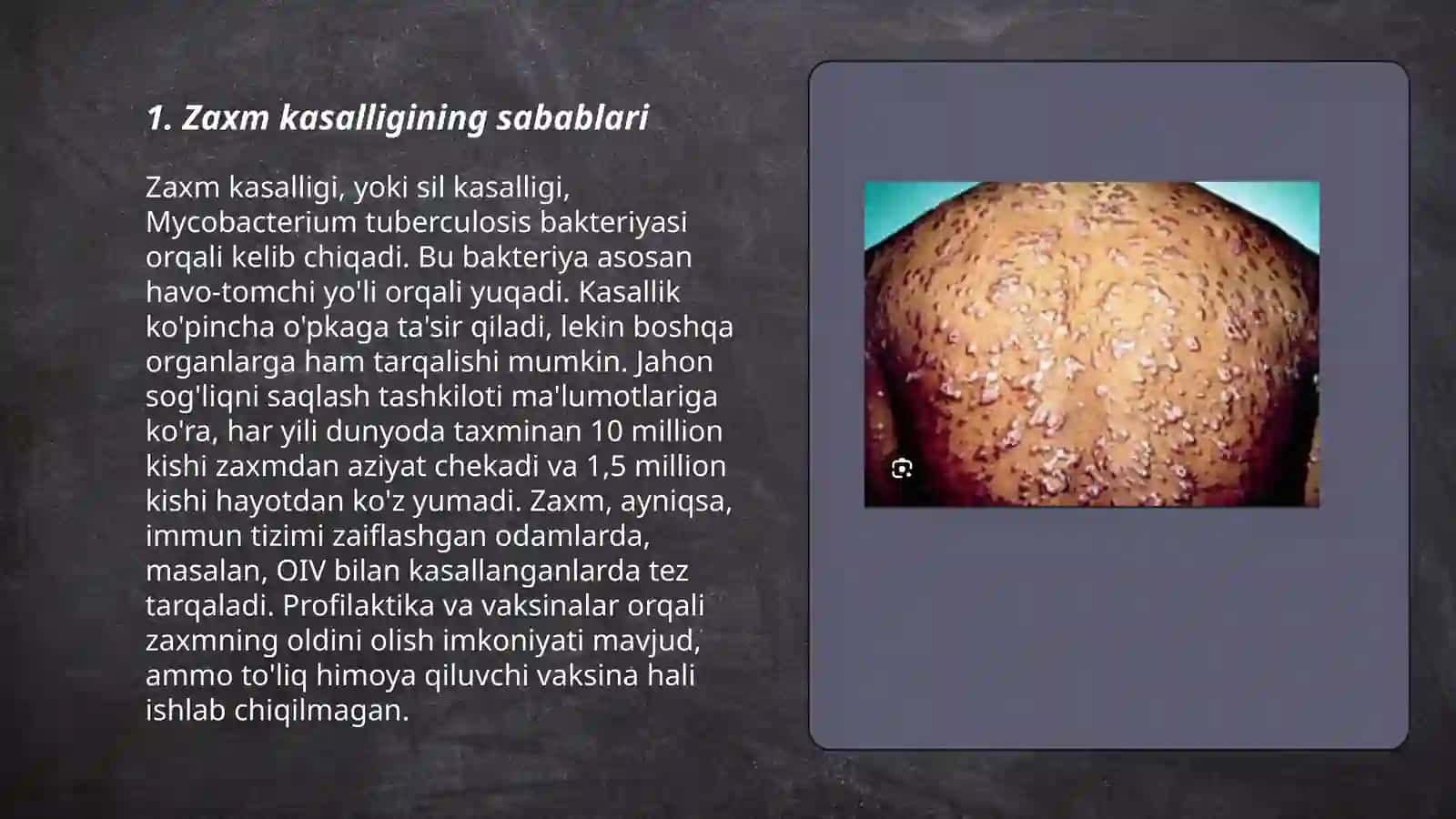 Zaxm kasalligi 3