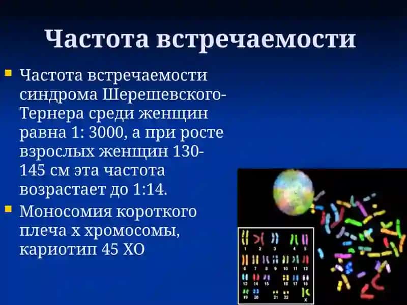 Синдром Шерешевского-Тернера 3