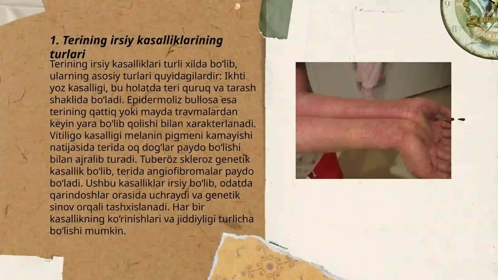 Terining (dermatozlar)nasliy kasalligi 3
