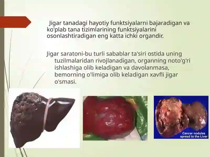 Gepatobilliarjoylashuvio`smasiJigarsaratoni 3