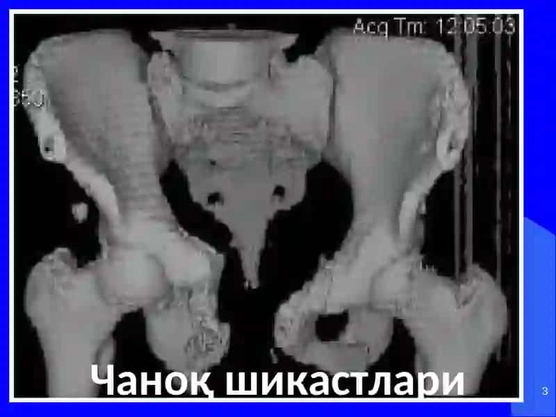 Чаноқ шикастлари 3