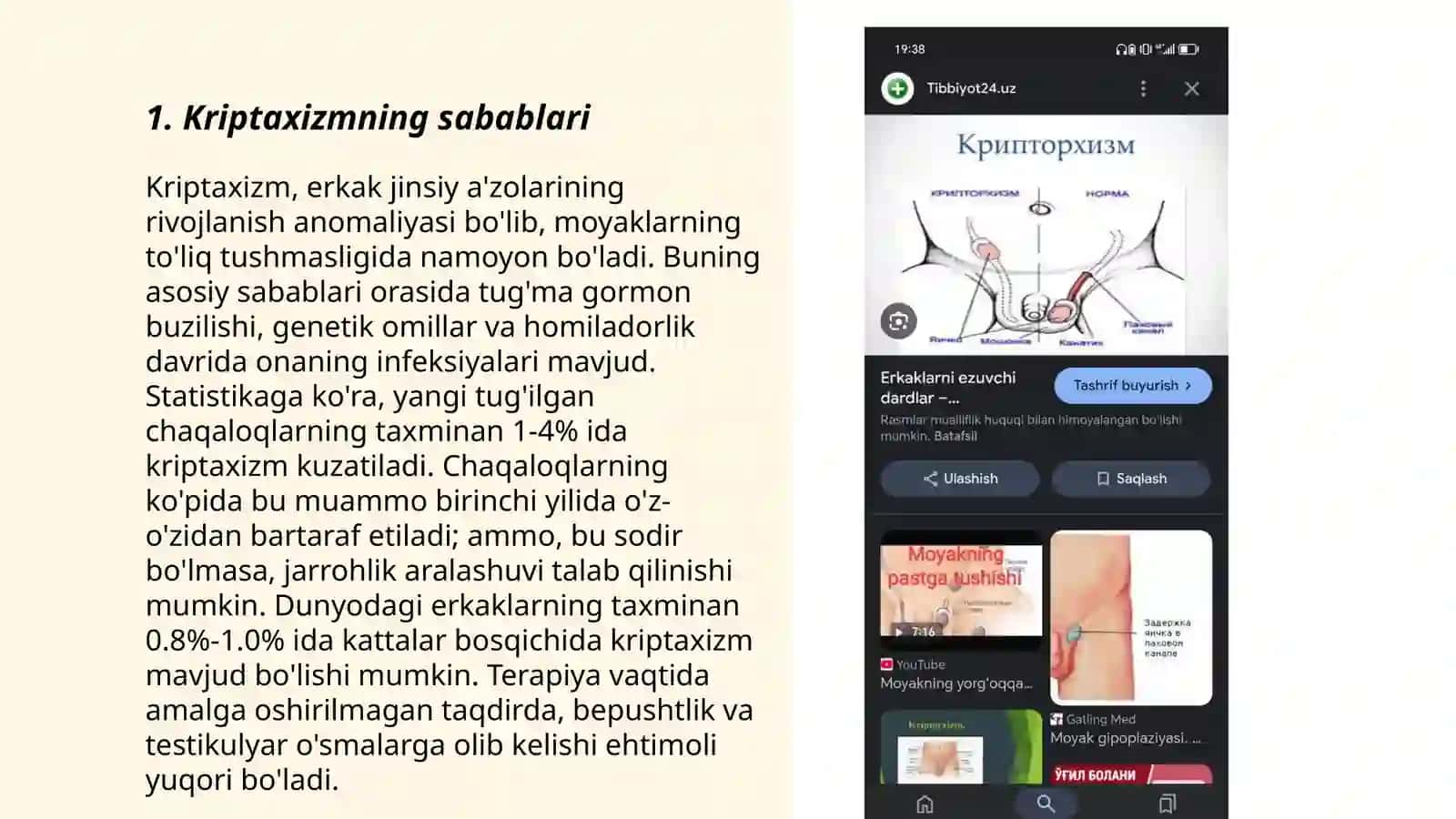 Kriptaxizm va uni davolash 3