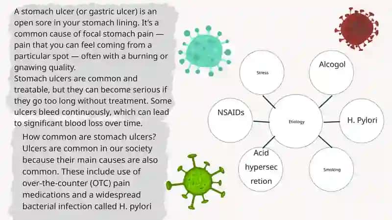 Gastric ulcer 3