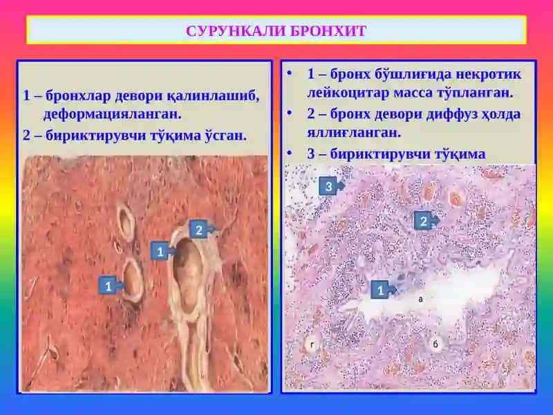 ЎПКАНИНГ СУРУНКАЛИ НОСПЕЦИФИК КАСАЛЛИКЛАРИ 3