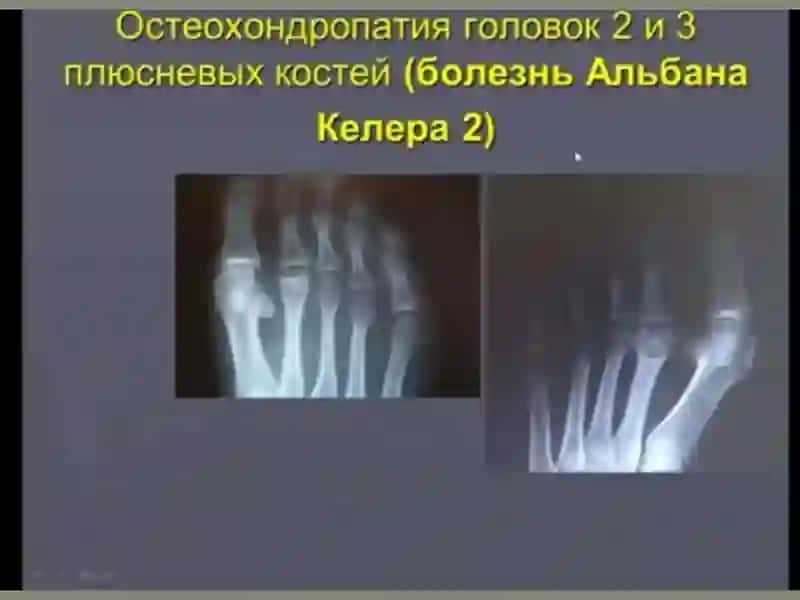 OSTEOXONDROPATIYA 3