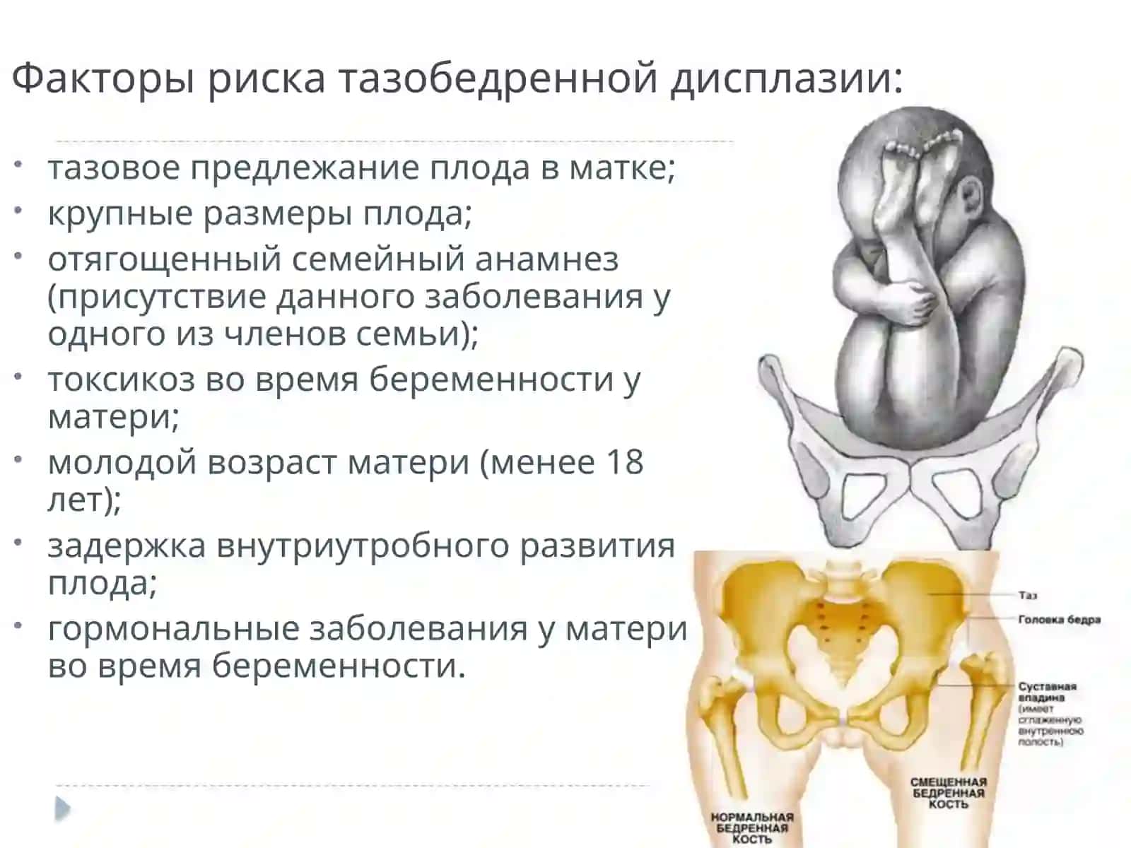 врожденные вывихи бедра косолапость 3