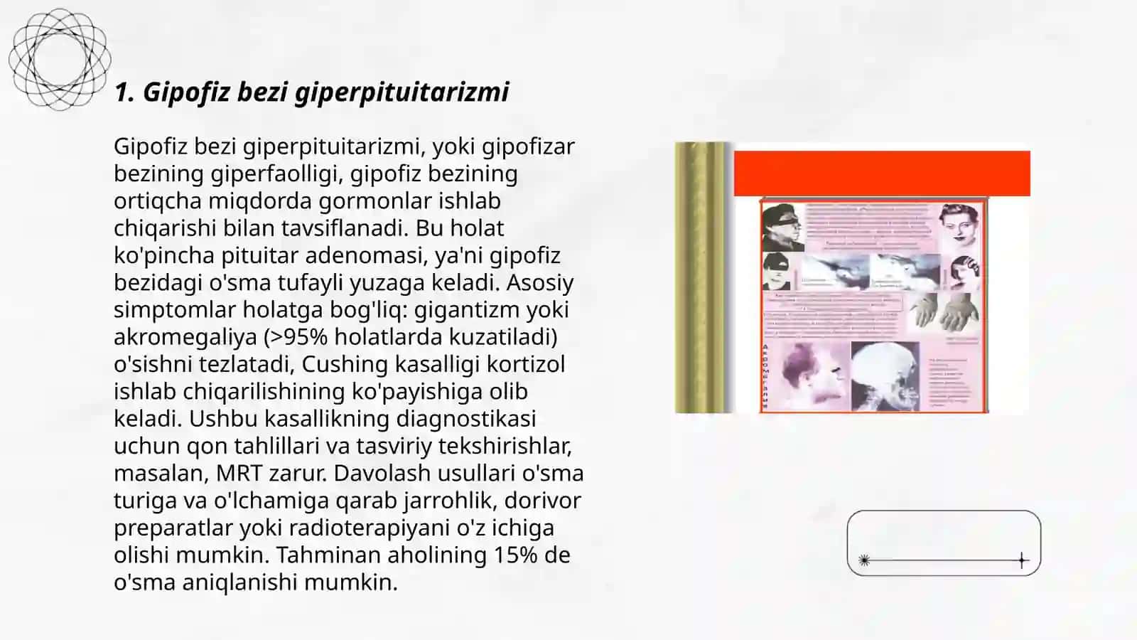 Giperpituitarizm G-insuloma 3