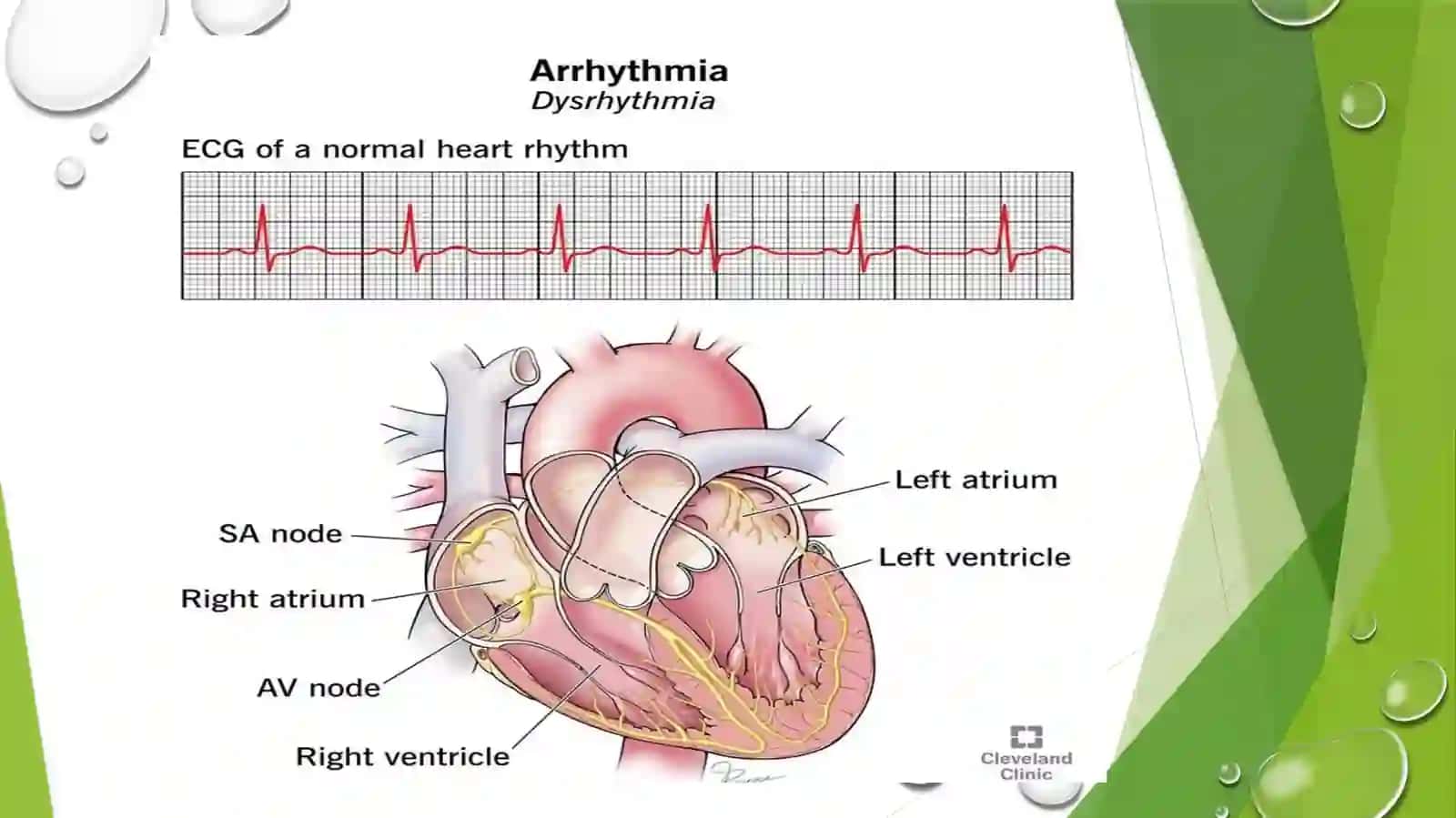 YurakaritmiyalariEKG diagnostikasi 3