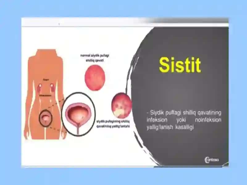 Bolalarda siydik yo‘llari infeksiyalari 3