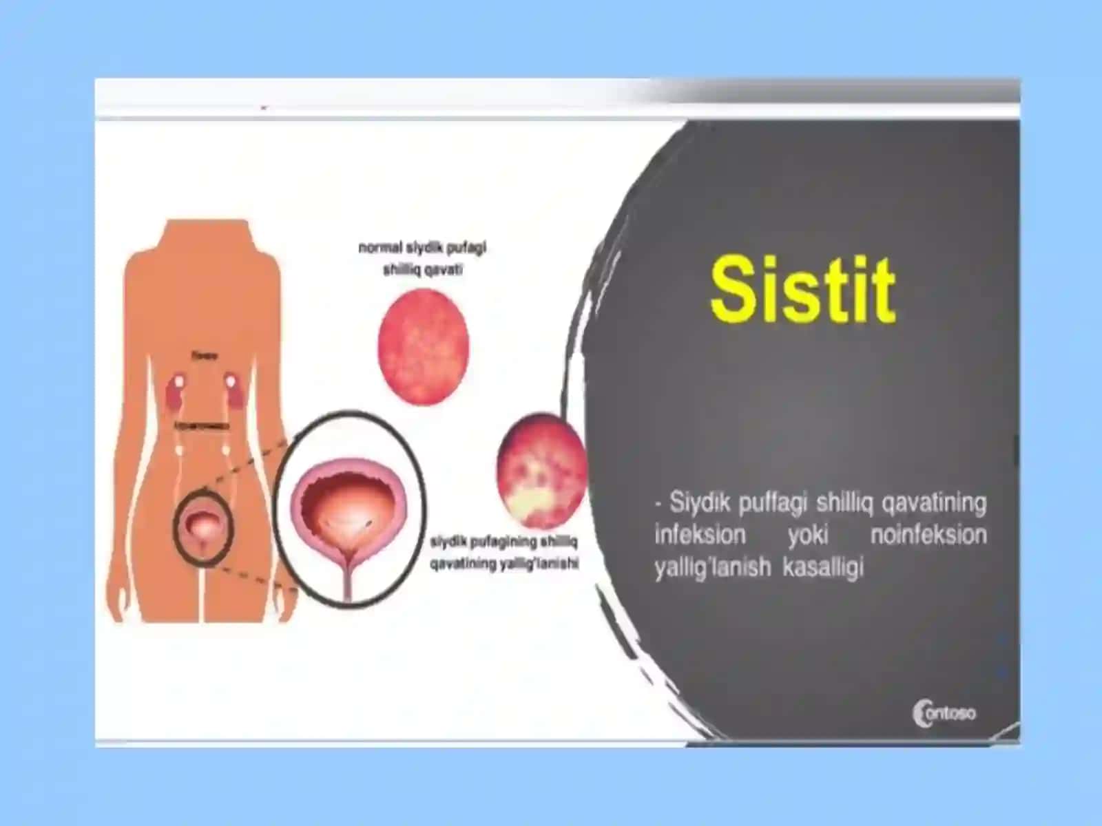 Bolalarda siydik yo‘llari infeksiyalari 3