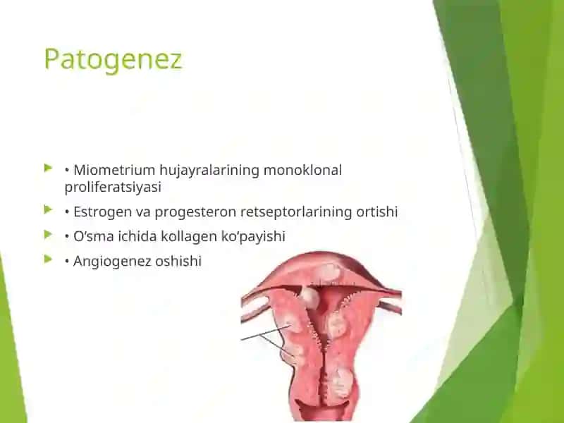 Mioma (Uterin Fibromiyoma) 3