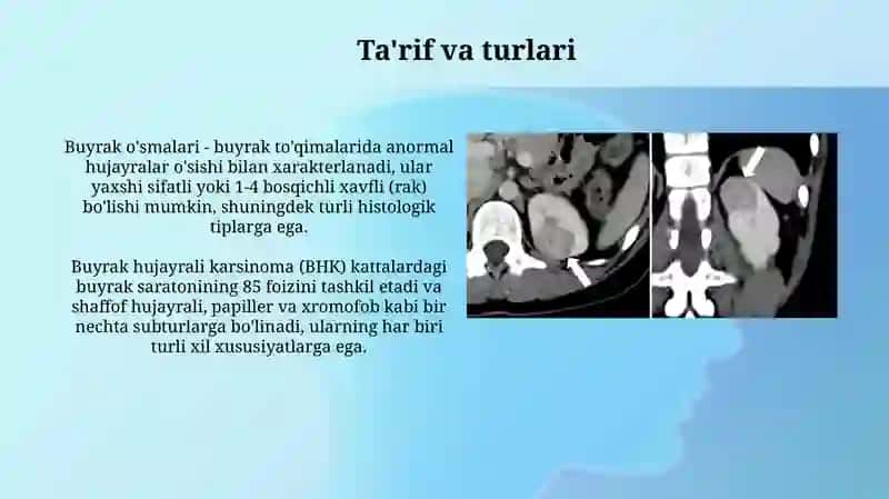 Buyrak oʻsmalari 3