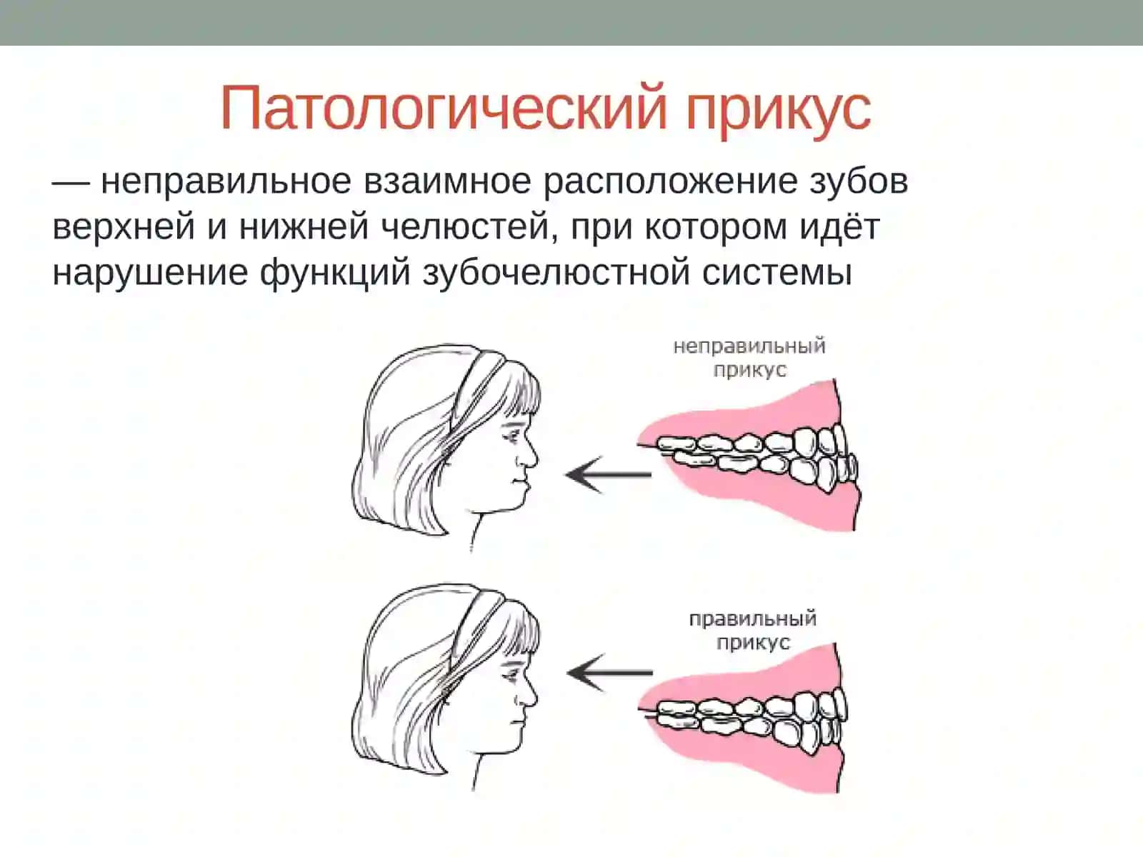 Прикусы. Виды патологических прикусов 3