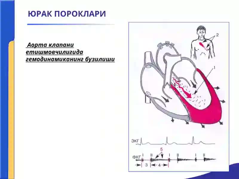 Аоrта клапанининг етишмовчилиги 3