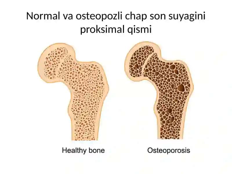 Osteoporoz kasalligi 3