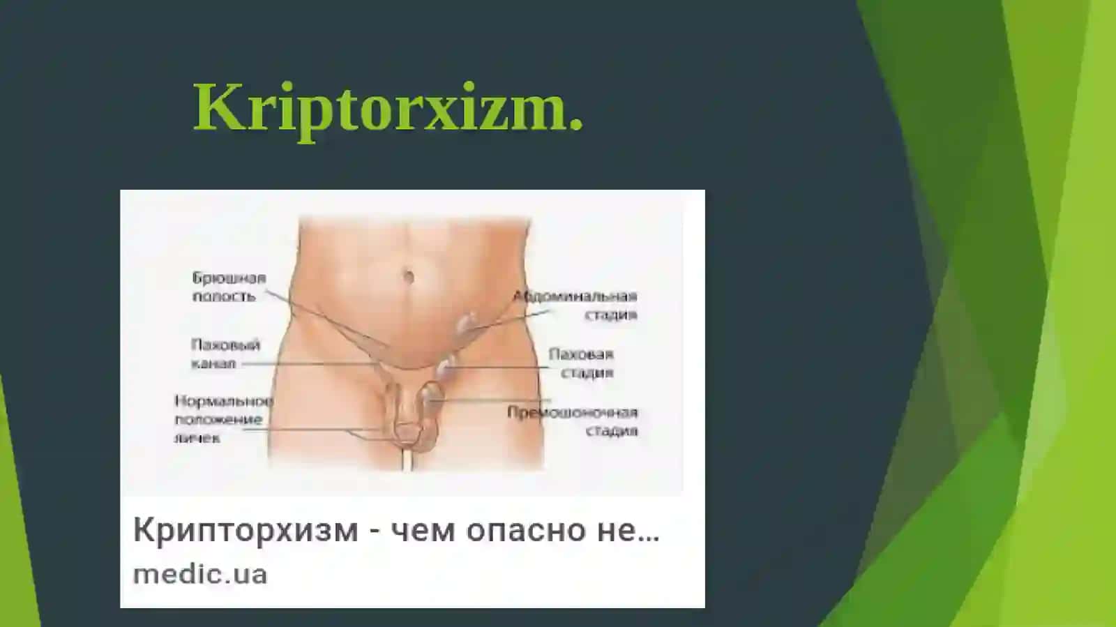 Kriptorxizm. Etiopatogenezi, klinikasi, diagnostikasi, davolash 3