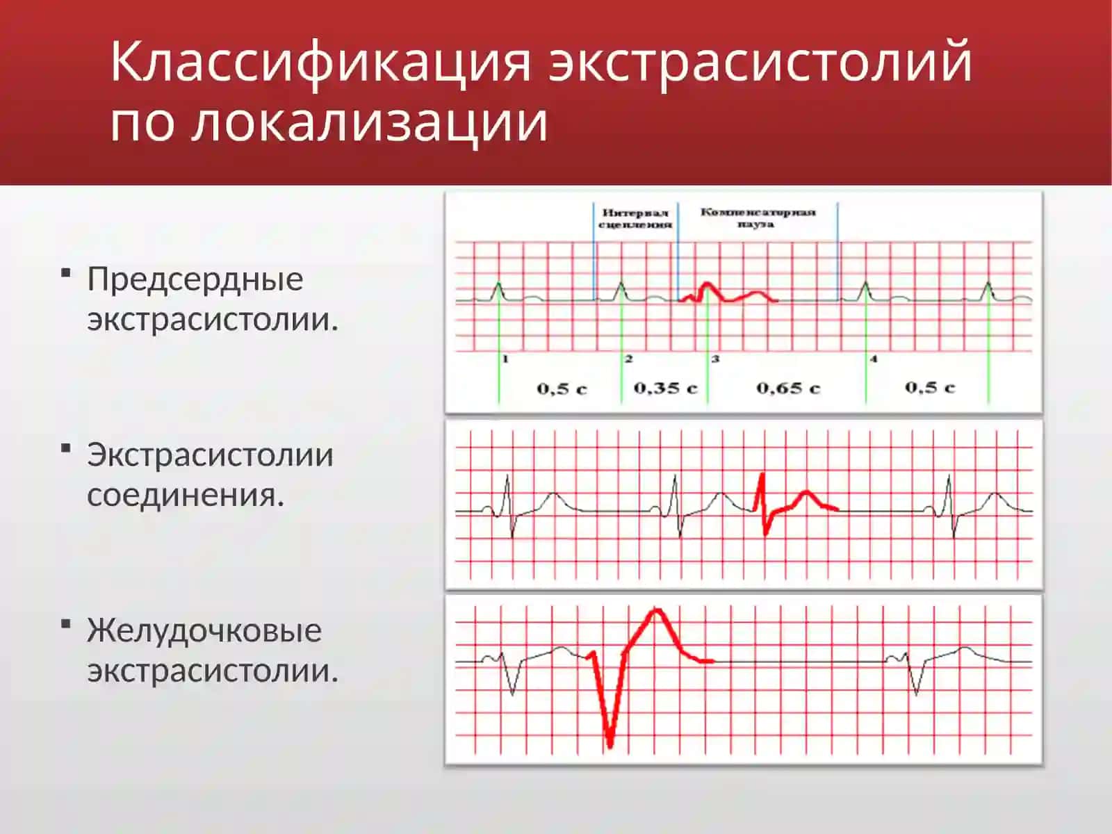 Экстрасистолии 3