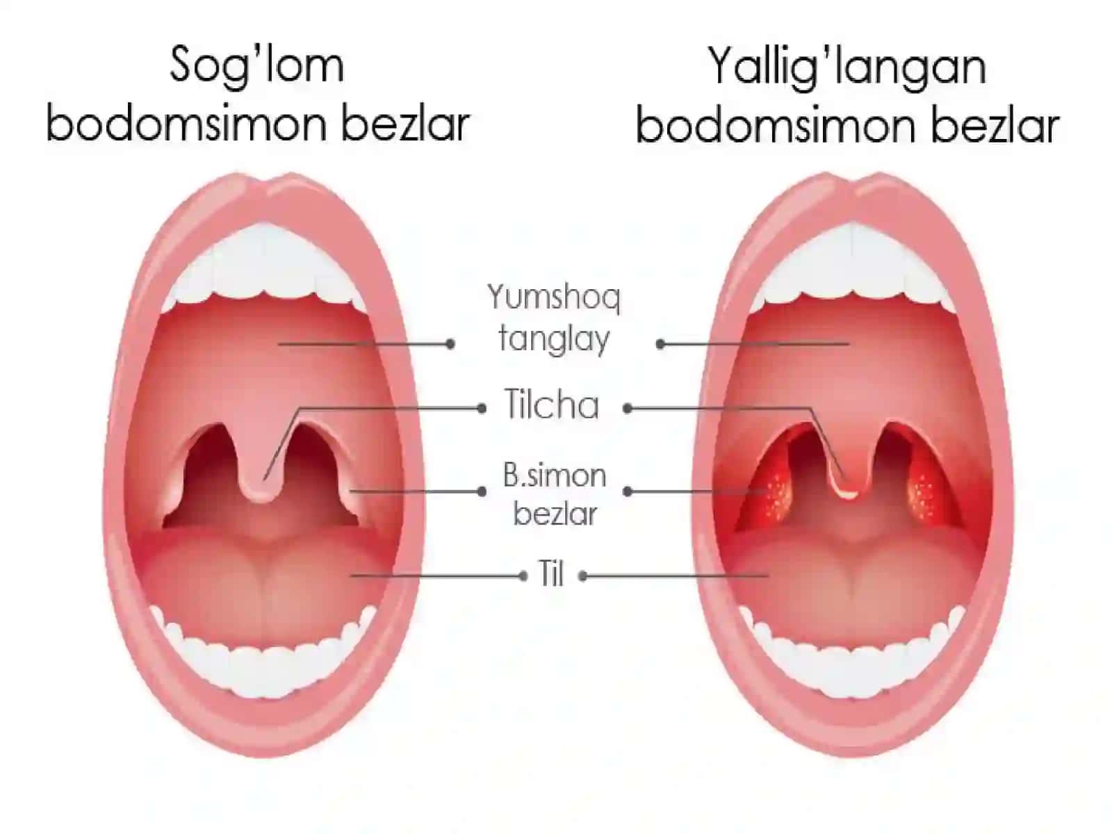 O’TKIR TONZILLIT (ANGINA) 3