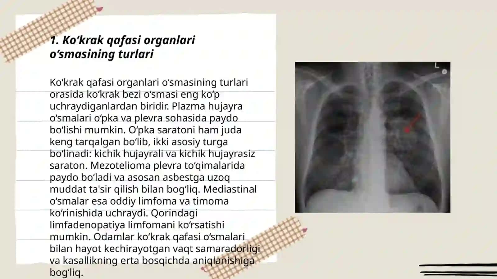 Ko‘krak qafasi organlari o‘smasi 3