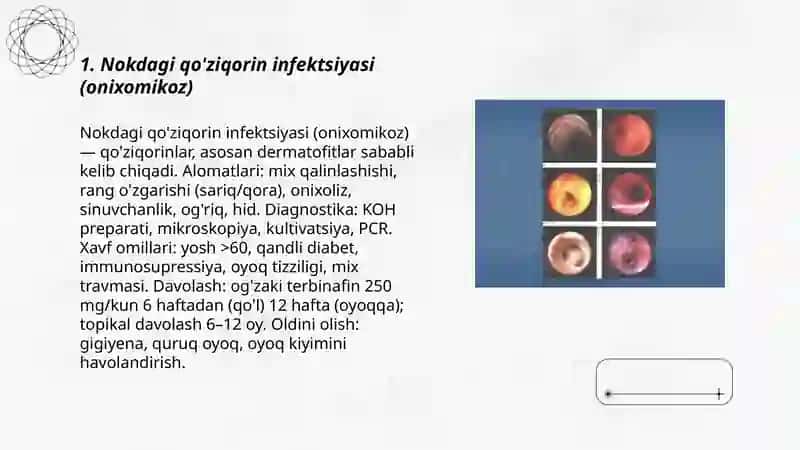 Nokdagi qo'ziqorin infektsiyasi (onixomikoz) 3