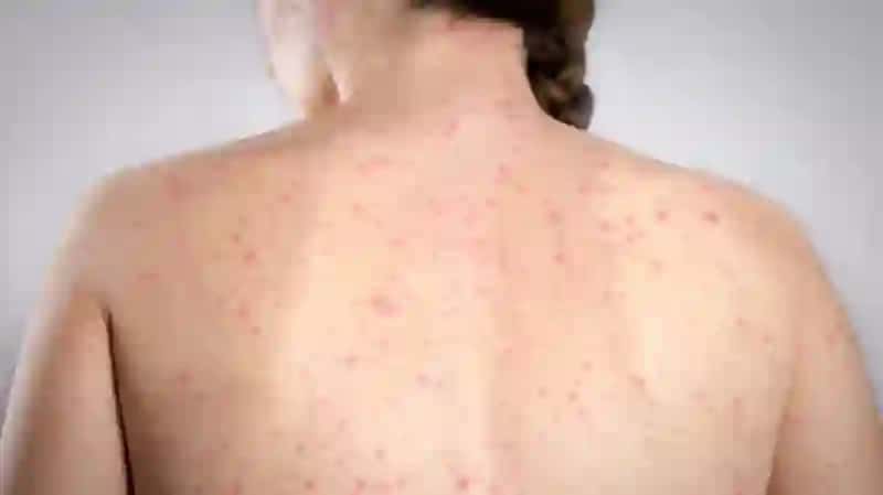 Pediatriyada amaliyotida ko’p uchrovchi infeksiyalar qo’zg’atuvchilari,patogenezi,laboratoriya tashhisi 3