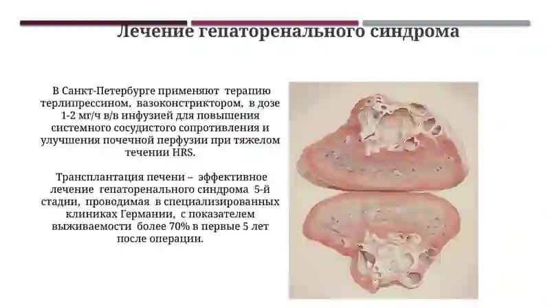 Диагностика и лечение гепаторенального синдрома 3