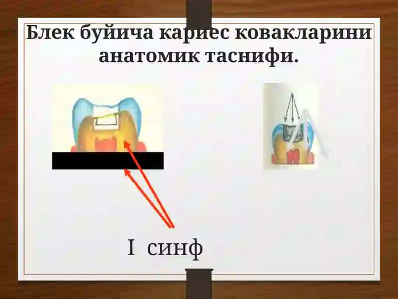 Кариес ковакни чархлаш босқичларивауслублари 3