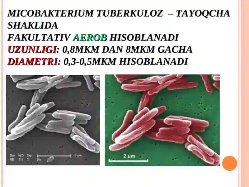 Tuberkuloz (SIL) – “TUBERCULE” (BOʻRTMACHA) SOʻZIDAN OLINGAN HISOBLANADI 3