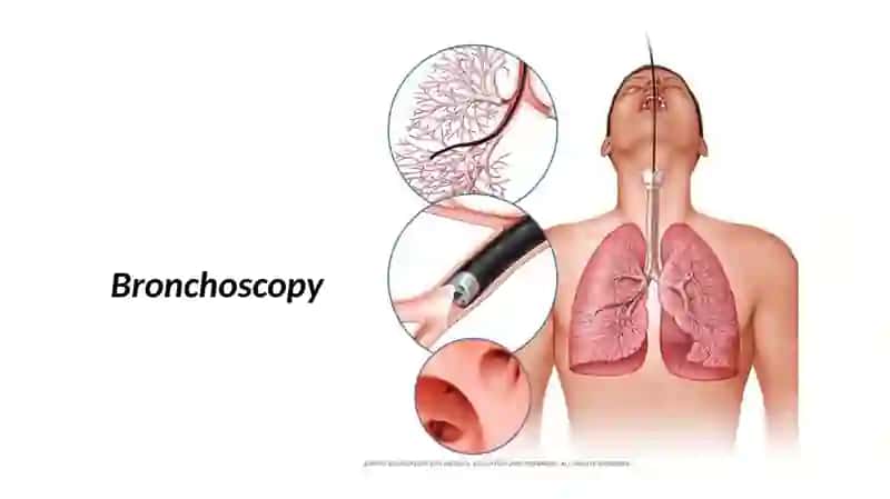Bronxoskopiya 3