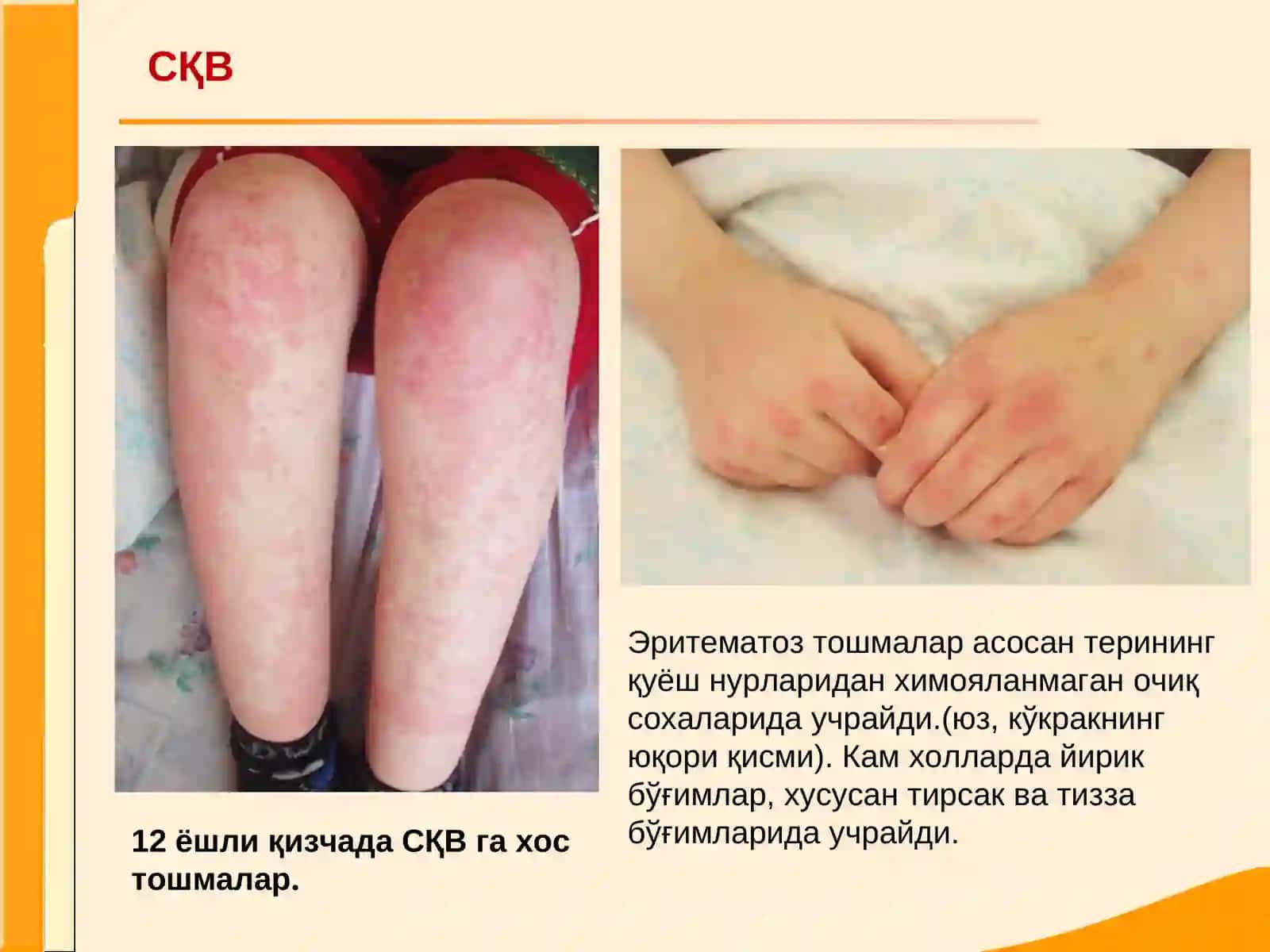 Системали кизил волчанка 3