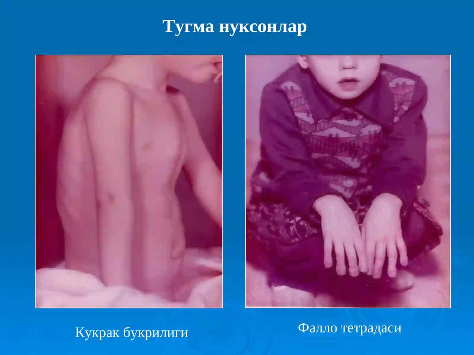 Туғма юракнуқсонлари 3